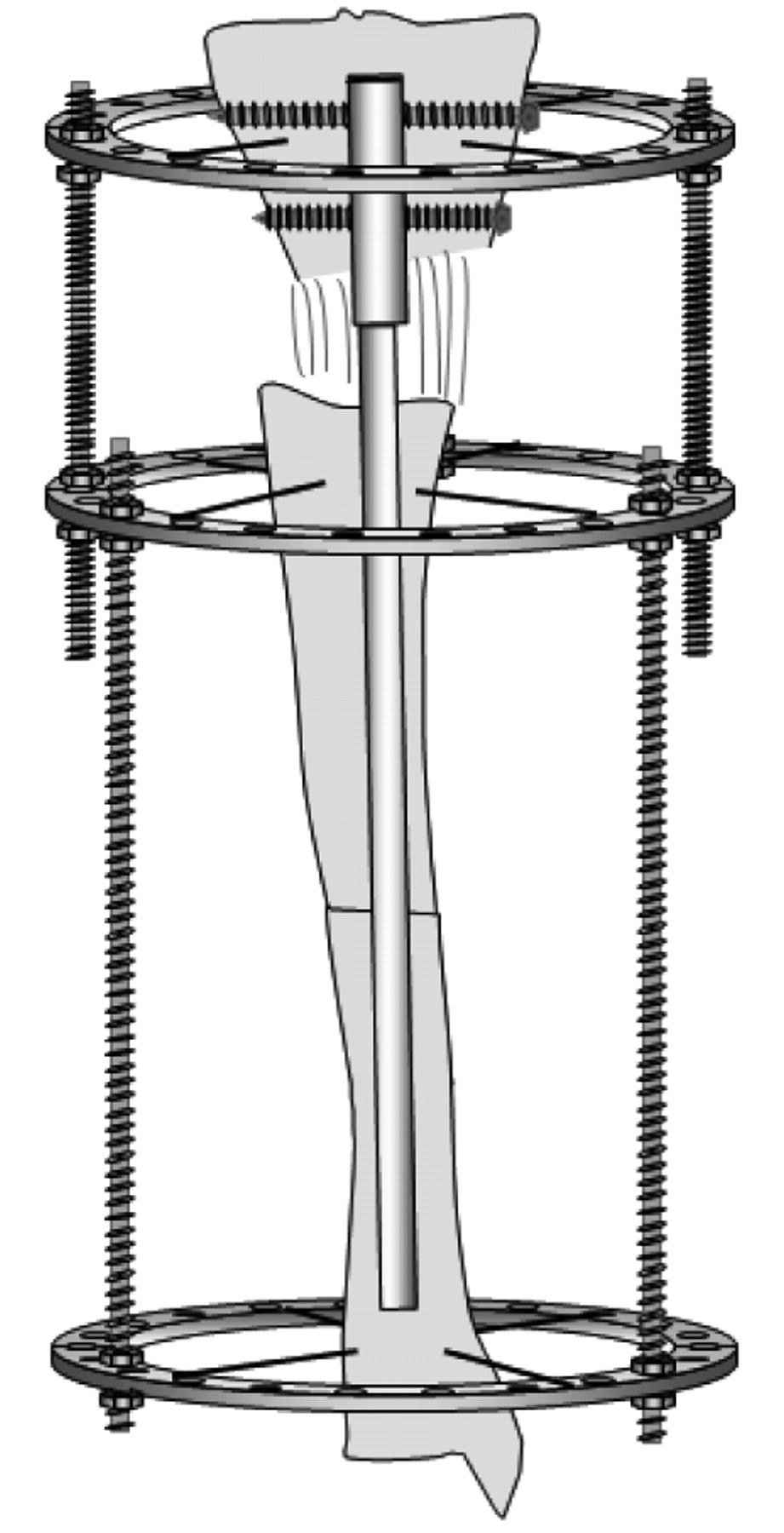 Fixator-assisted Nailing And Consecutive Lengthening Over An ...