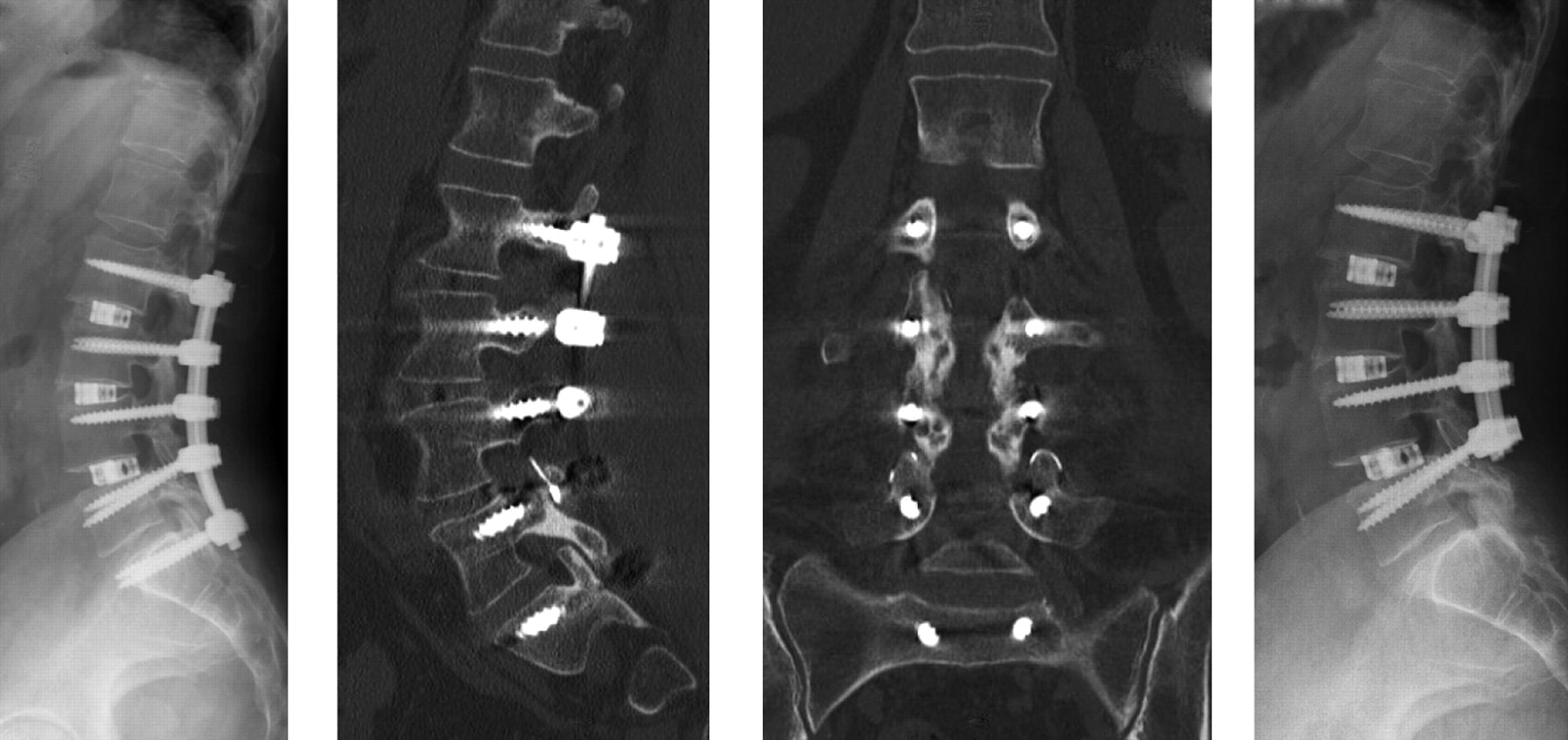 Pedicle Fracture