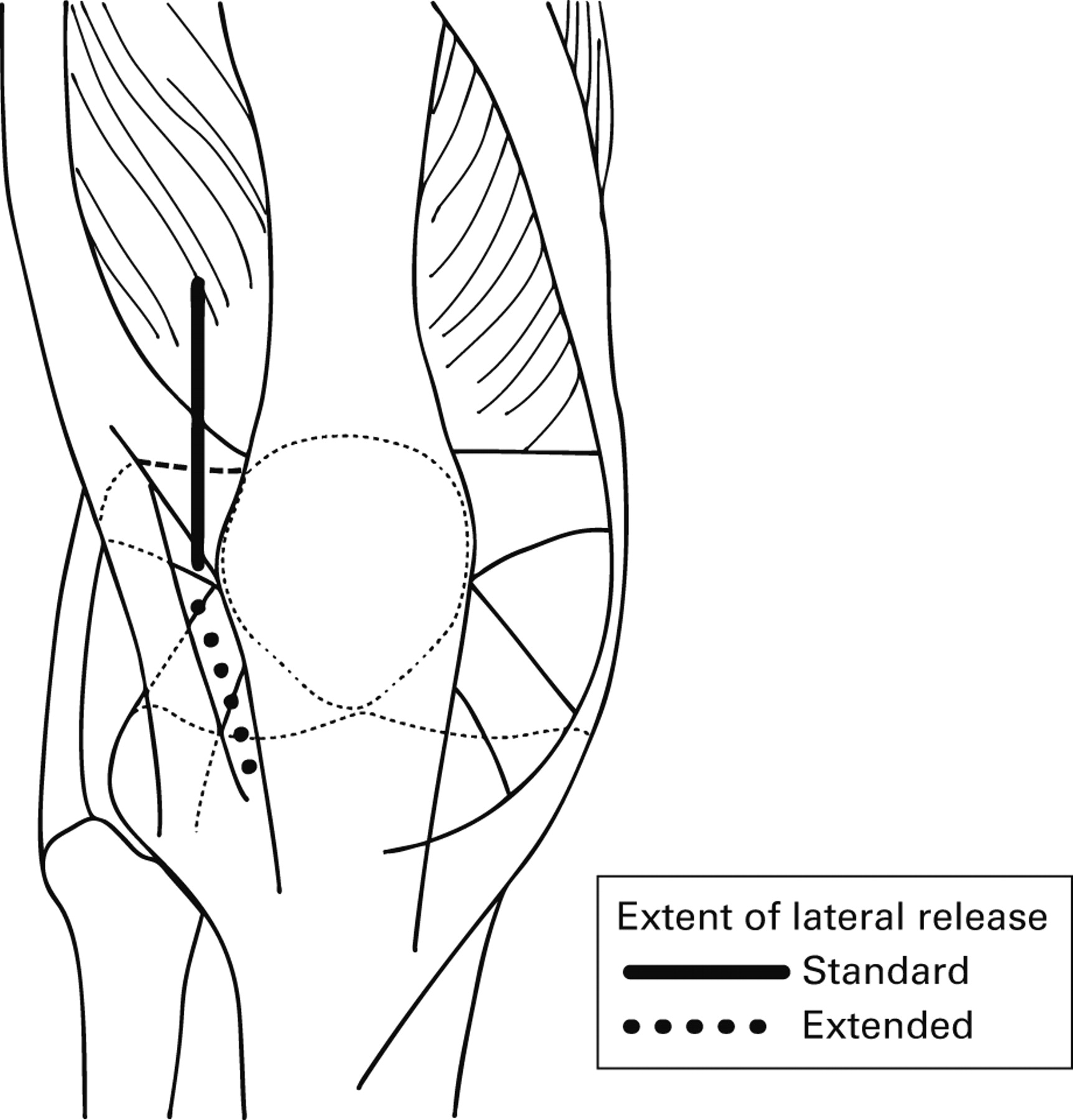 What Is The Role Of Lateral Retinacular Release Bone And Joint 1752