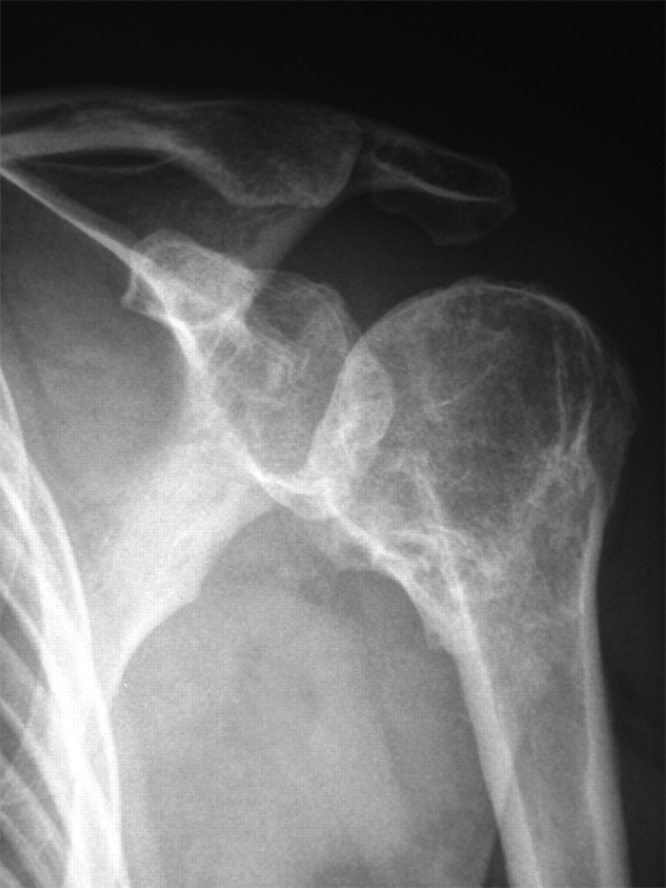 Humeral surface replacement for the sequelae of fractures of the ...