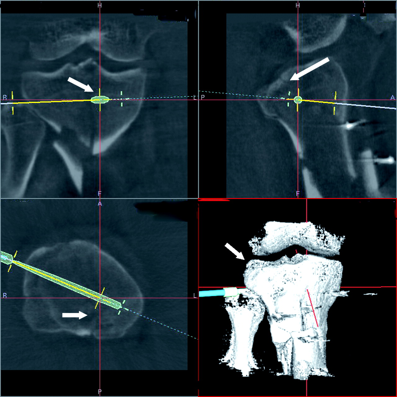 Image-guided navigation in orthopaedic trauma | Bone & Joint