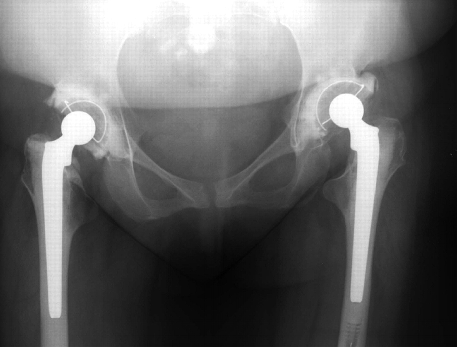 Bilateral Hip Replacement In Three Patients With Lysosomal Storage