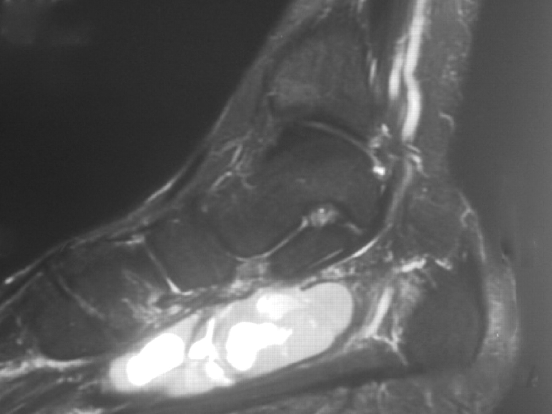 Limb salvage for soft-tissue sarcomas of the foot and ankle | Bone & Joint