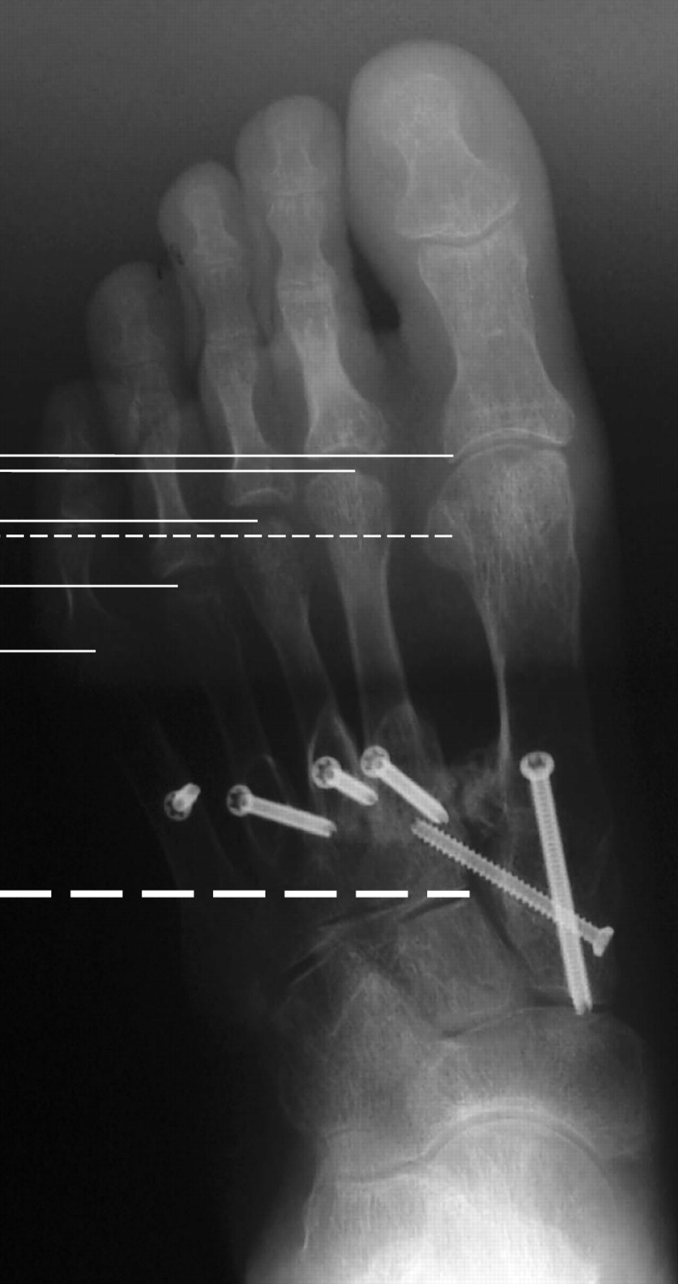 Combination Joint-preserving Surgery For Forefoot Deformity In Patients ...