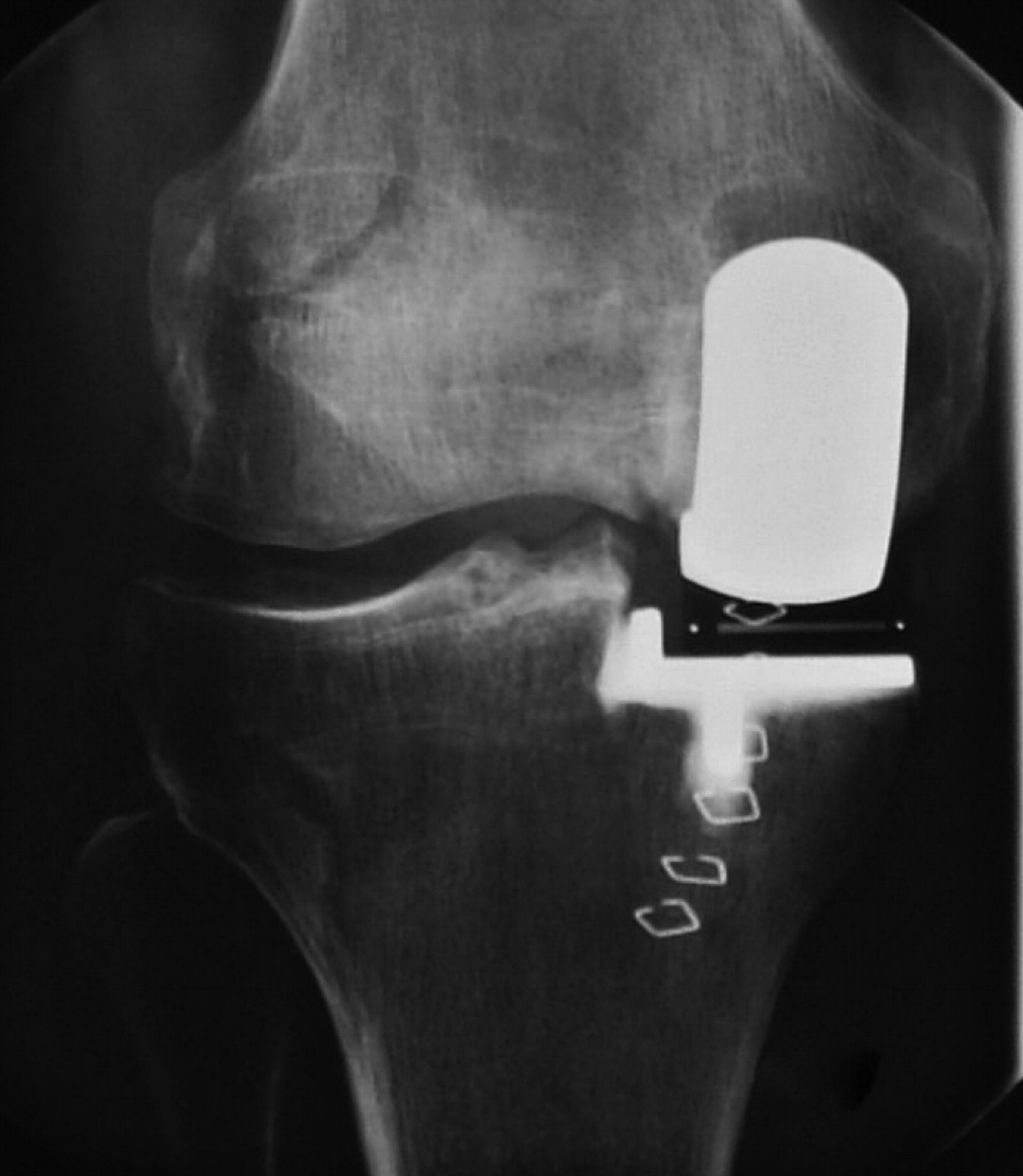 The Implications Of Damage To The Lateral Femoral Condyle On Medial 