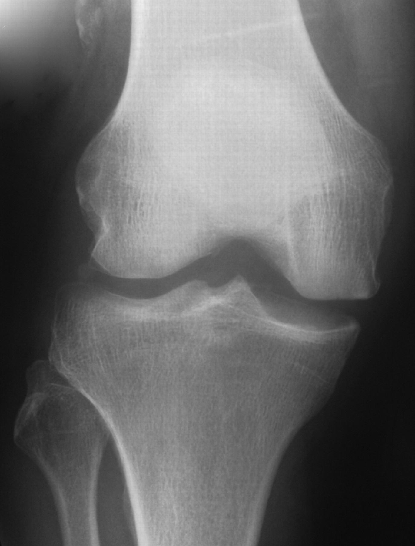 The Implications Of Damage To The Lateral Femoral Condyle On Medial 