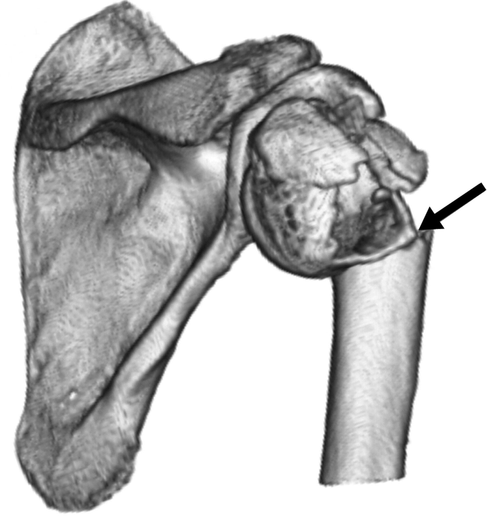 Classification Of Proximal Humeral Fractures Based On - vrogue.co