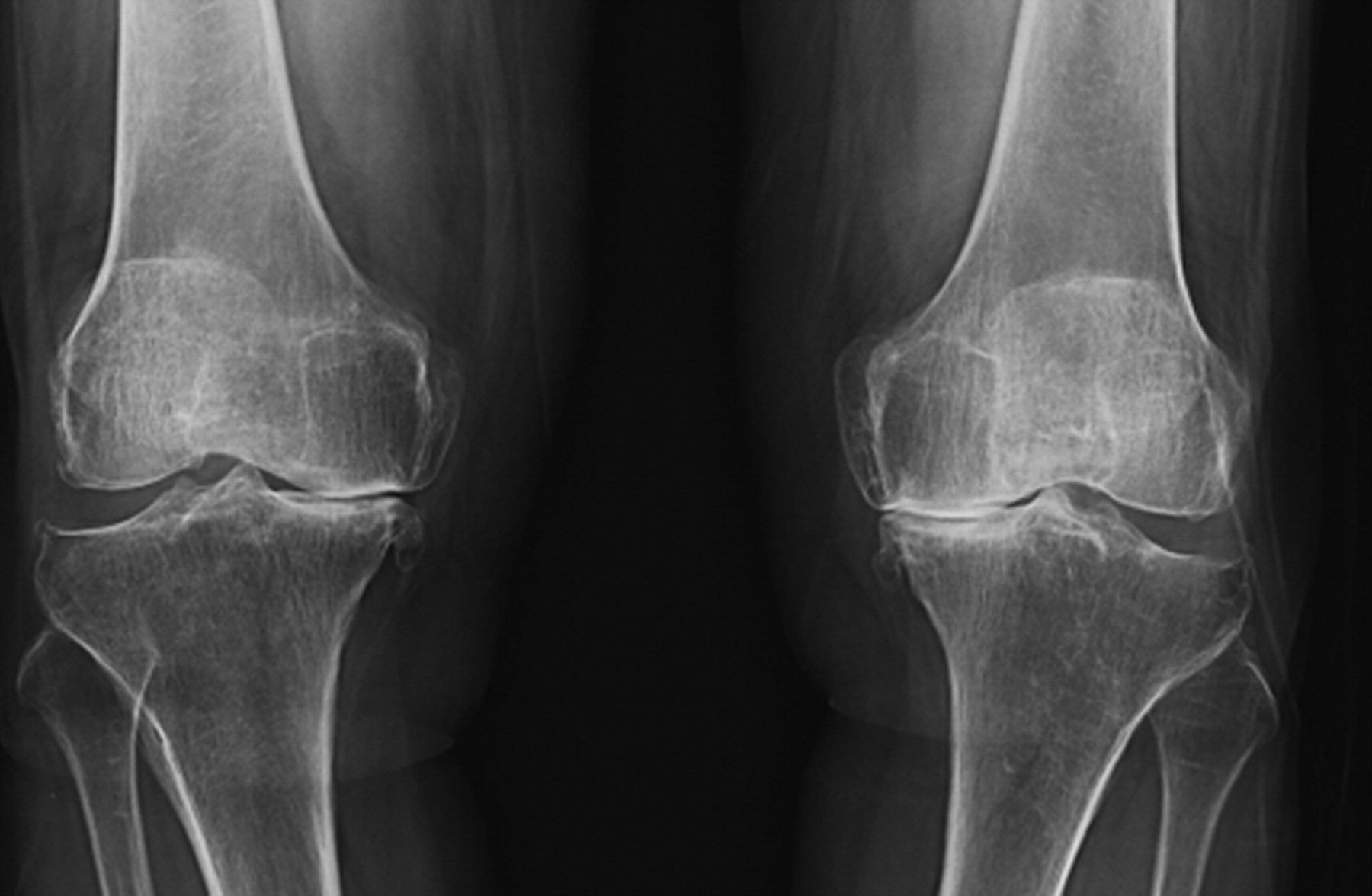 Comparison of standard and gender-specific posterior-cruciate-retaining ...