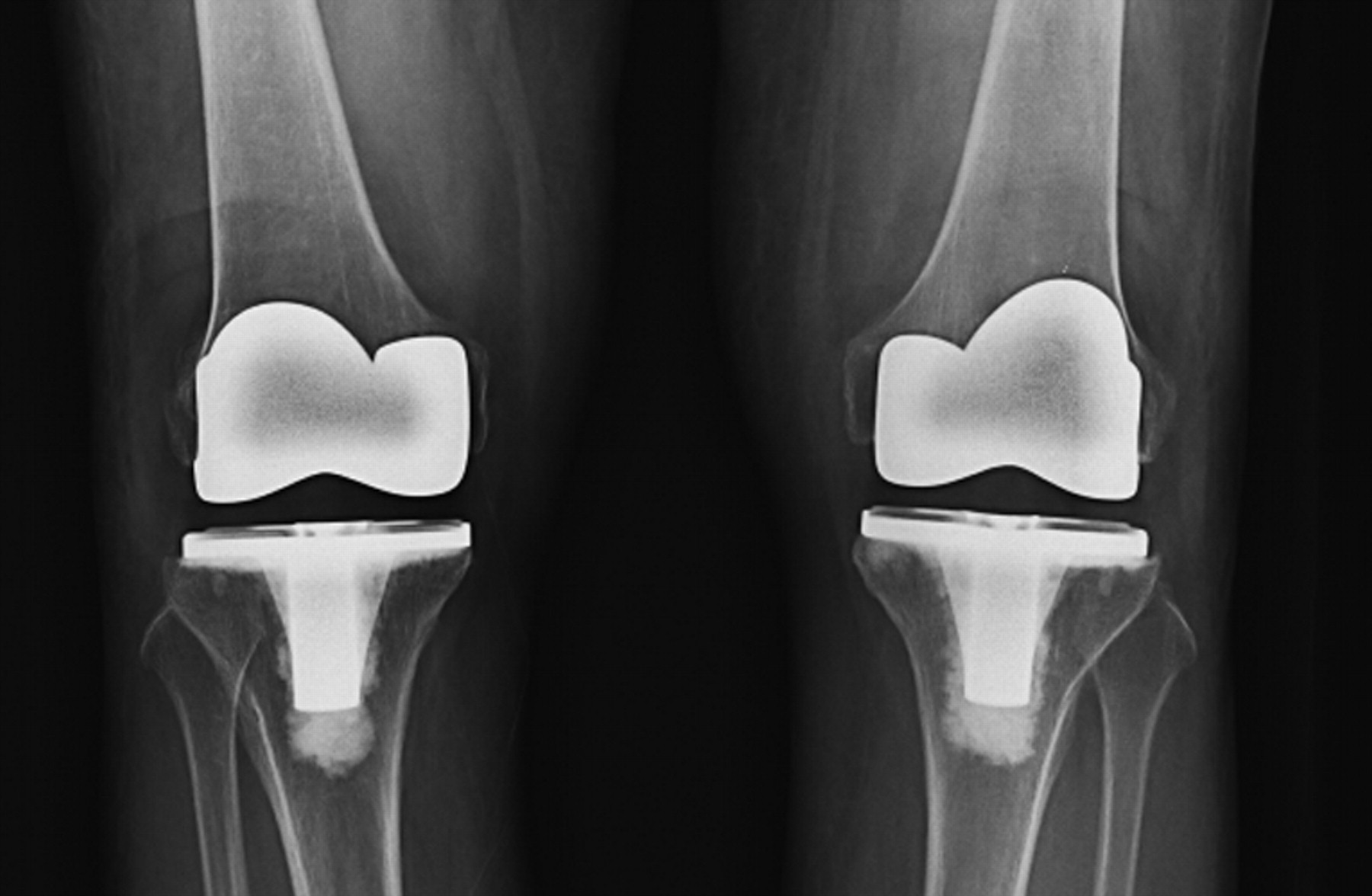 Comparison of standard and gender-specific posterior-cruciate-retaining ...