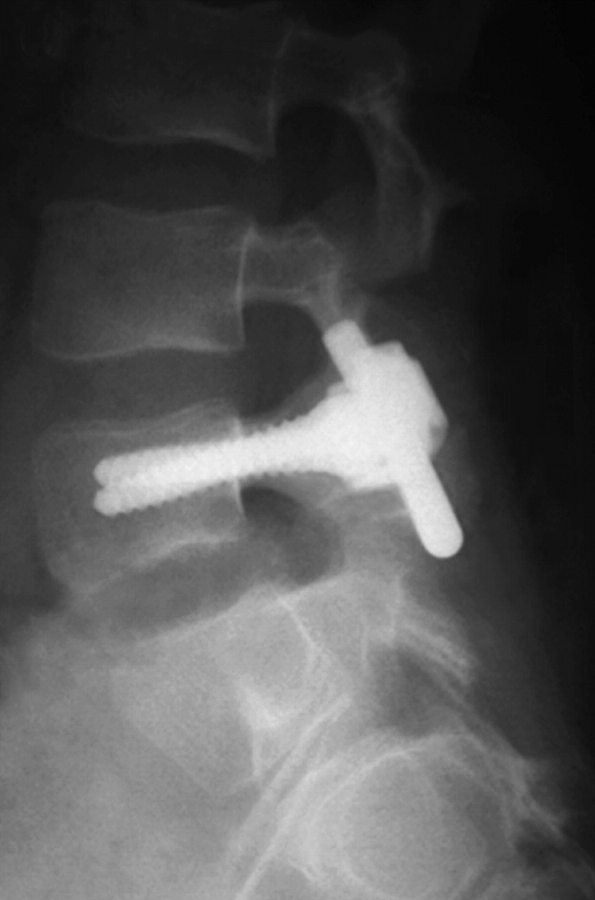 Spondylolysis And Spondylolisthesis In Children And Adolescents | Bone ...