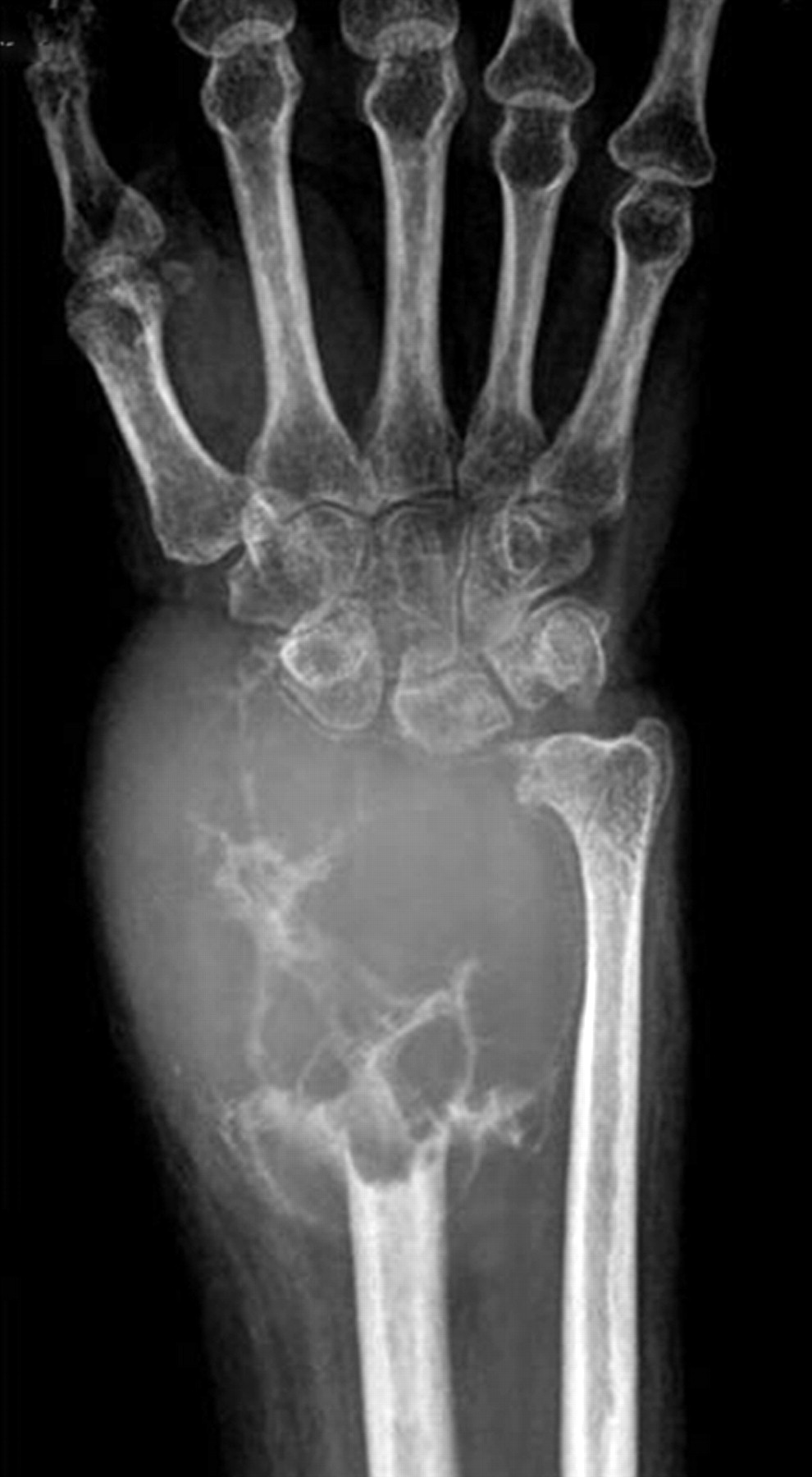 Ulnar Translocation After Excision Of A Campanacci Grade-3 Giant-cell ...