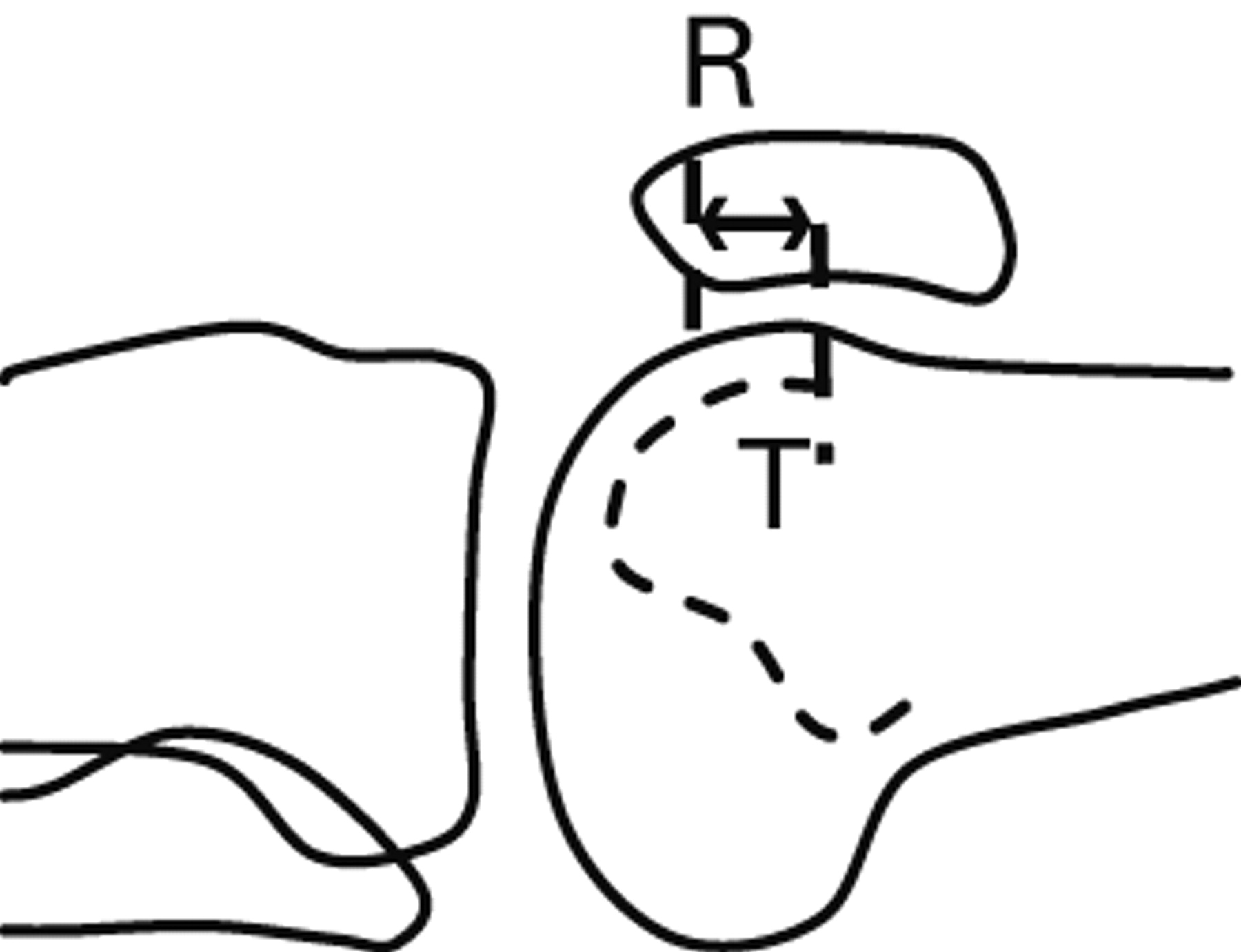 The Measurement Of Patellar Height | Bone & Joint