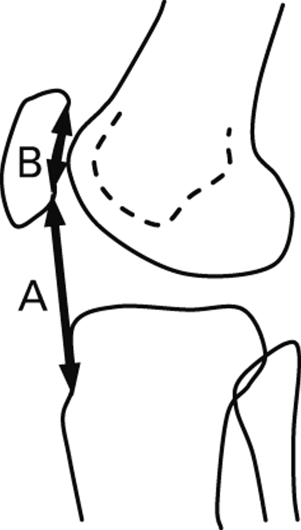 The Measurement Of Patellar Height | Bone & Joint