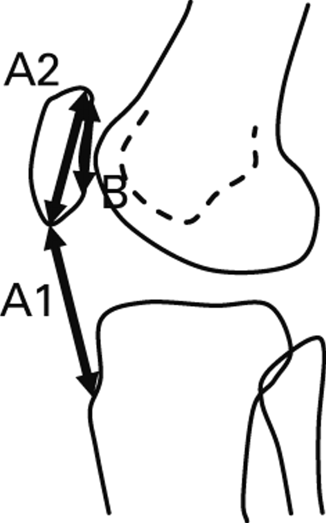 The Measurement Of Patellar Height | Bone & Joint