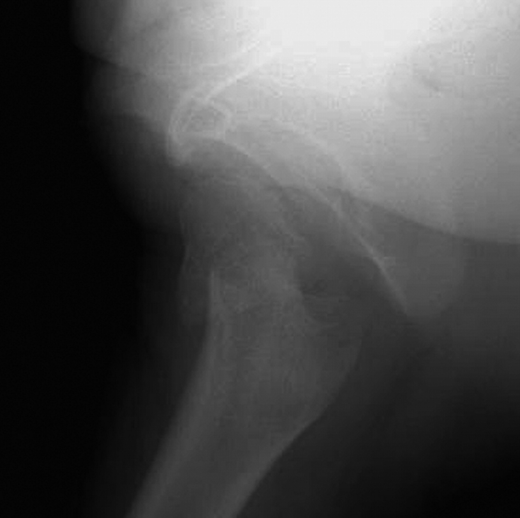 case study 3 1 displaced fracture of the femoral neck