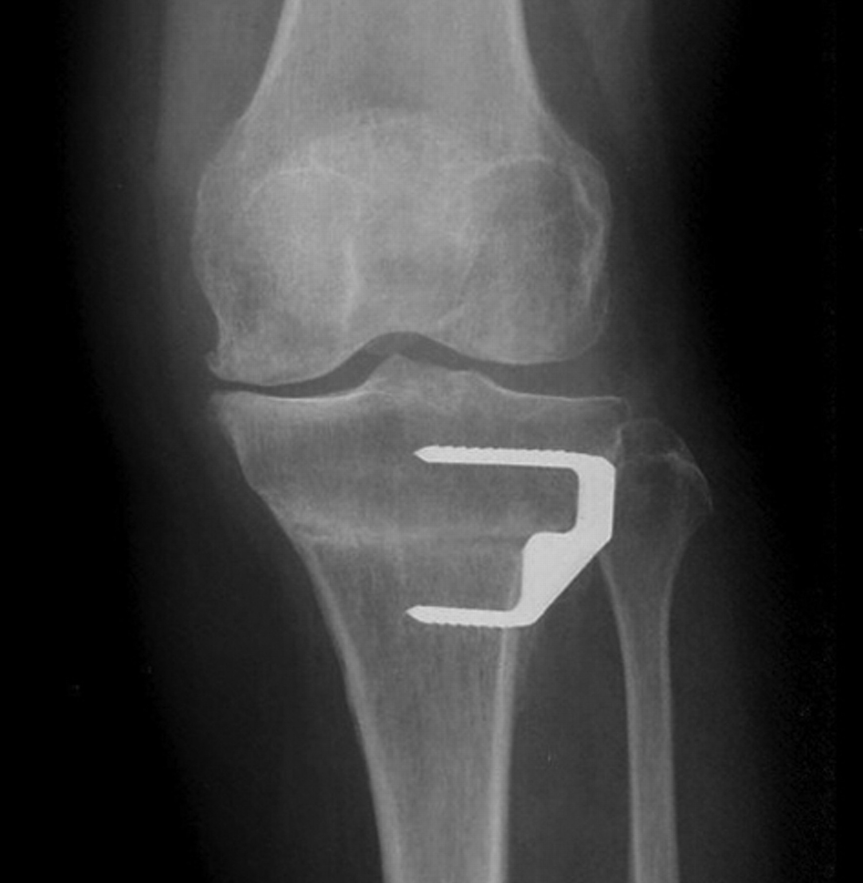 The Complications Of High Tibial Osteotomy 