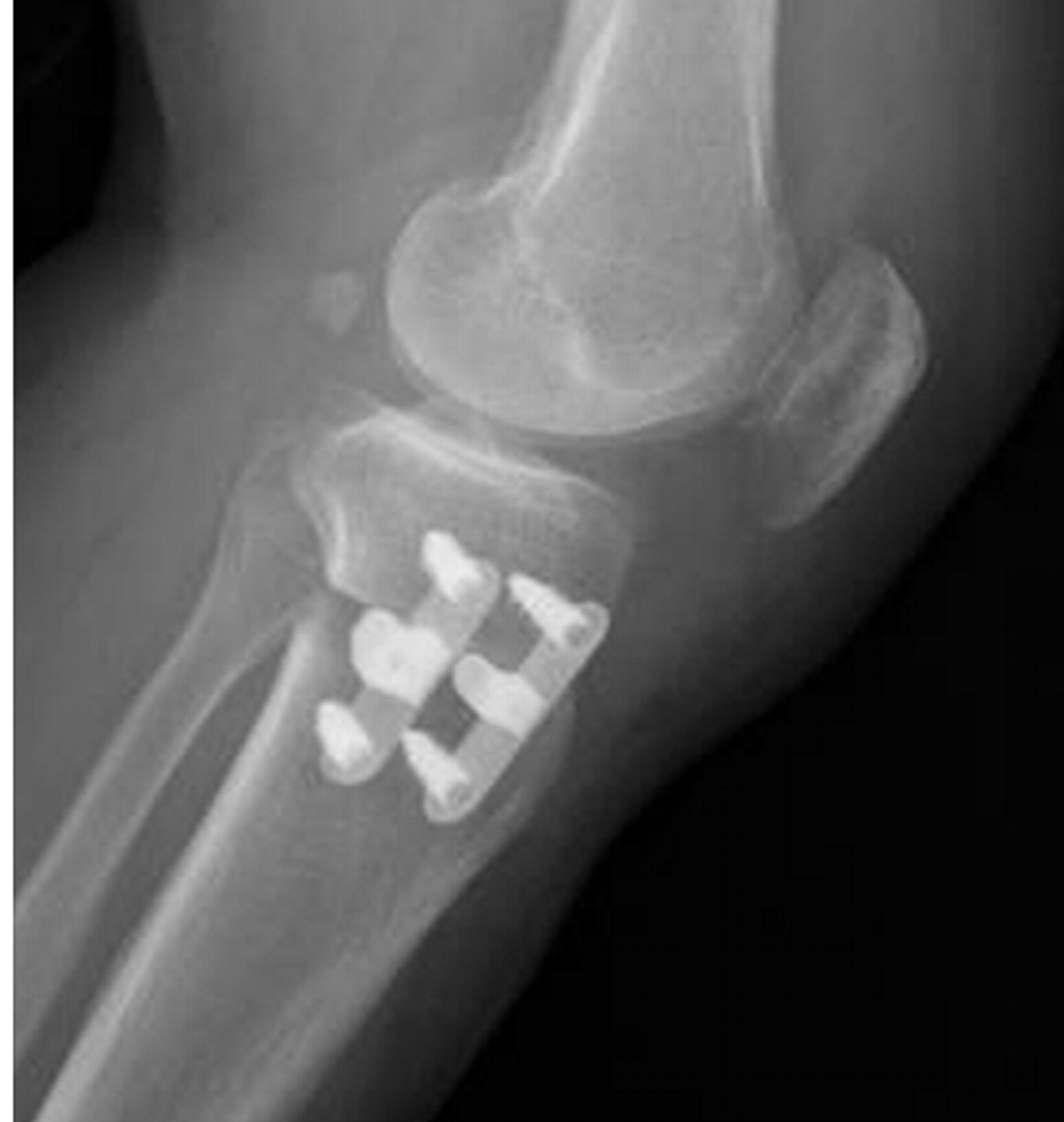 The Complications Of High Tibial Osteotomy | Bone & Joint