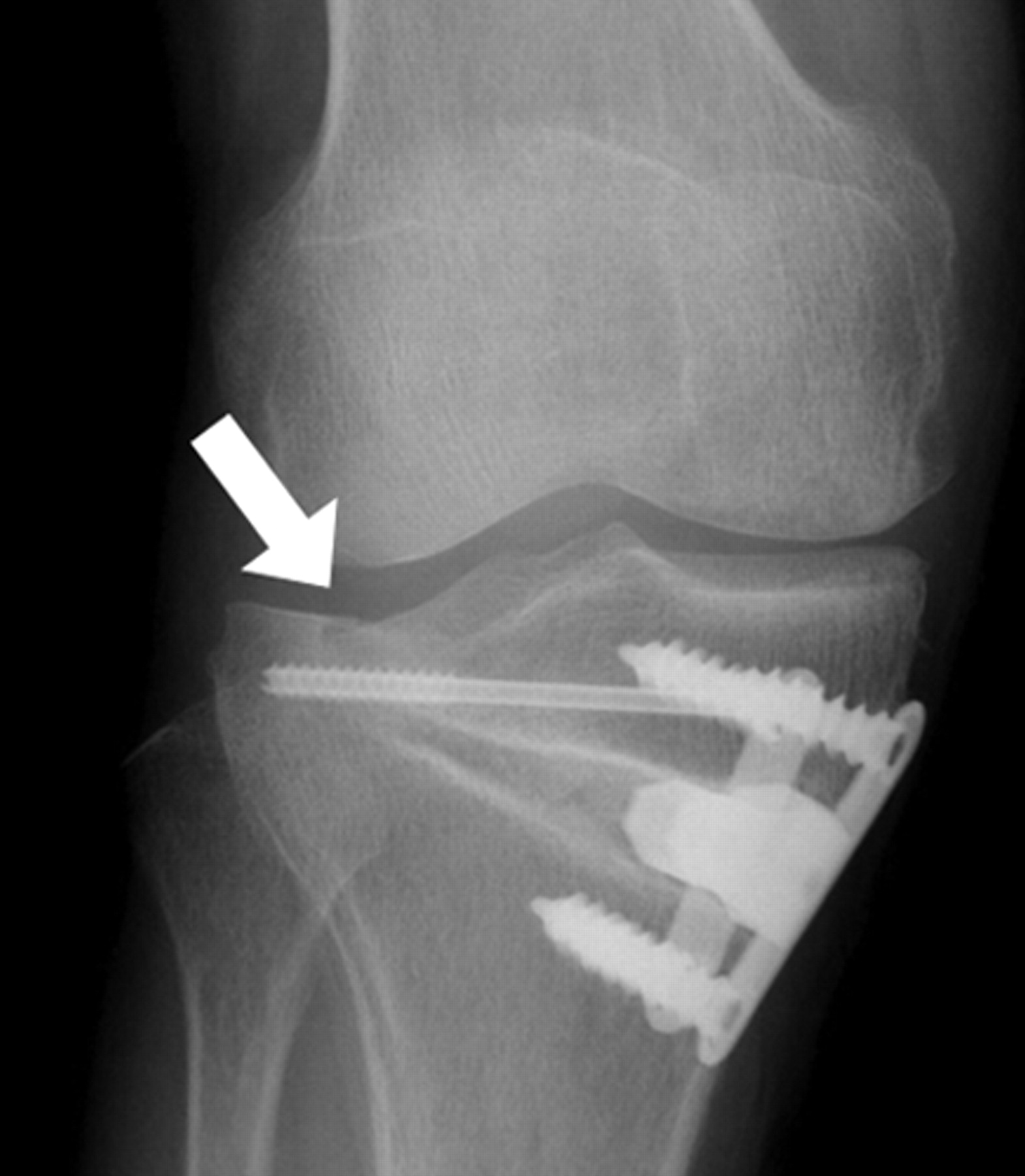 The Complications Of High Tibial Osteotomy | Bone & Joint