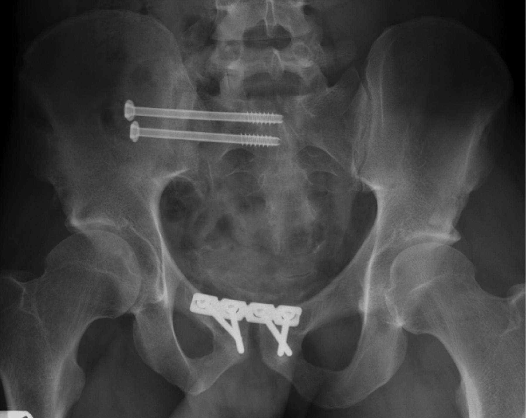 Open reduction and internal fixation of a traumatic diastasis of the ...