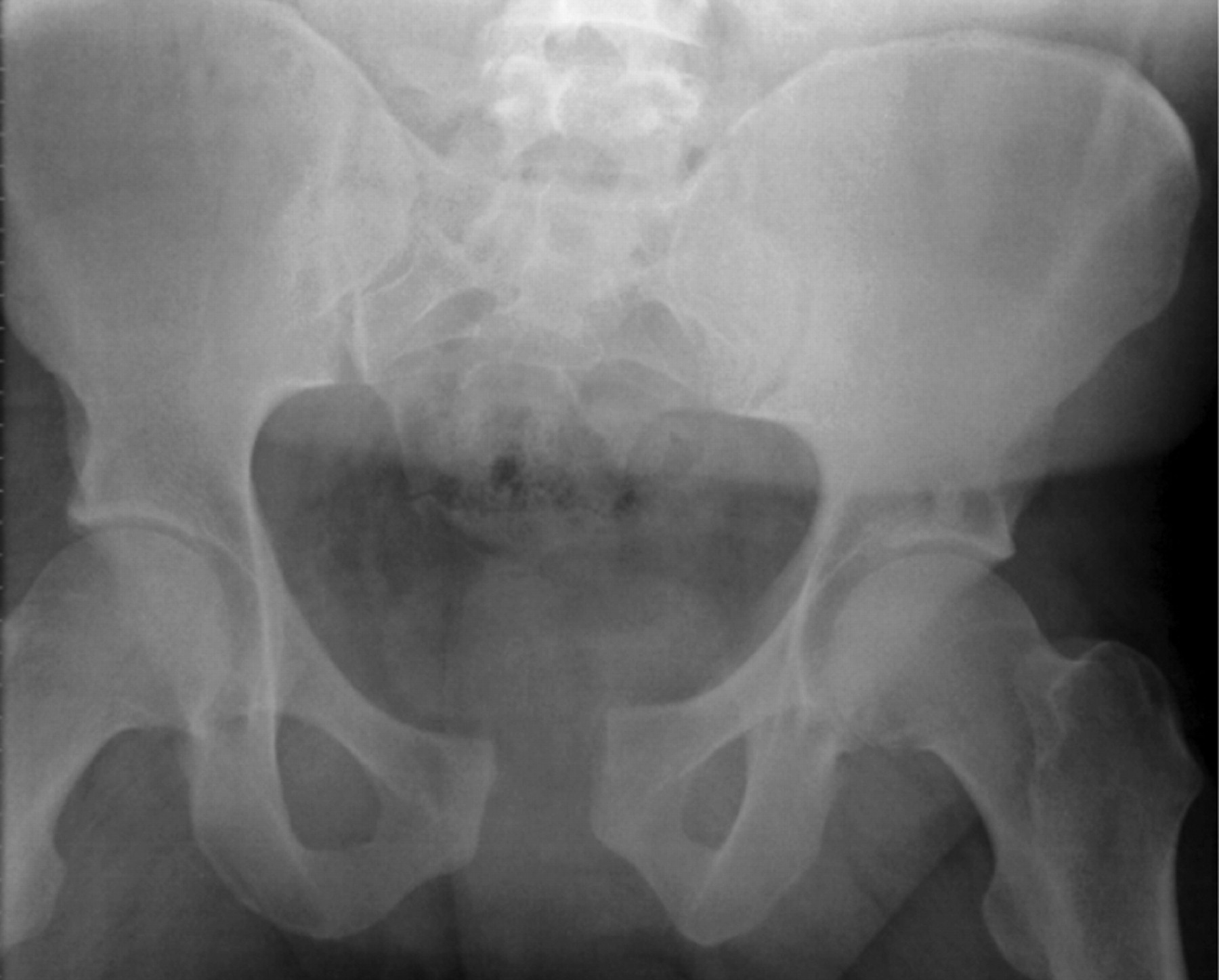 Open reduction and internal fixation of a traumatic diastasis of the ...