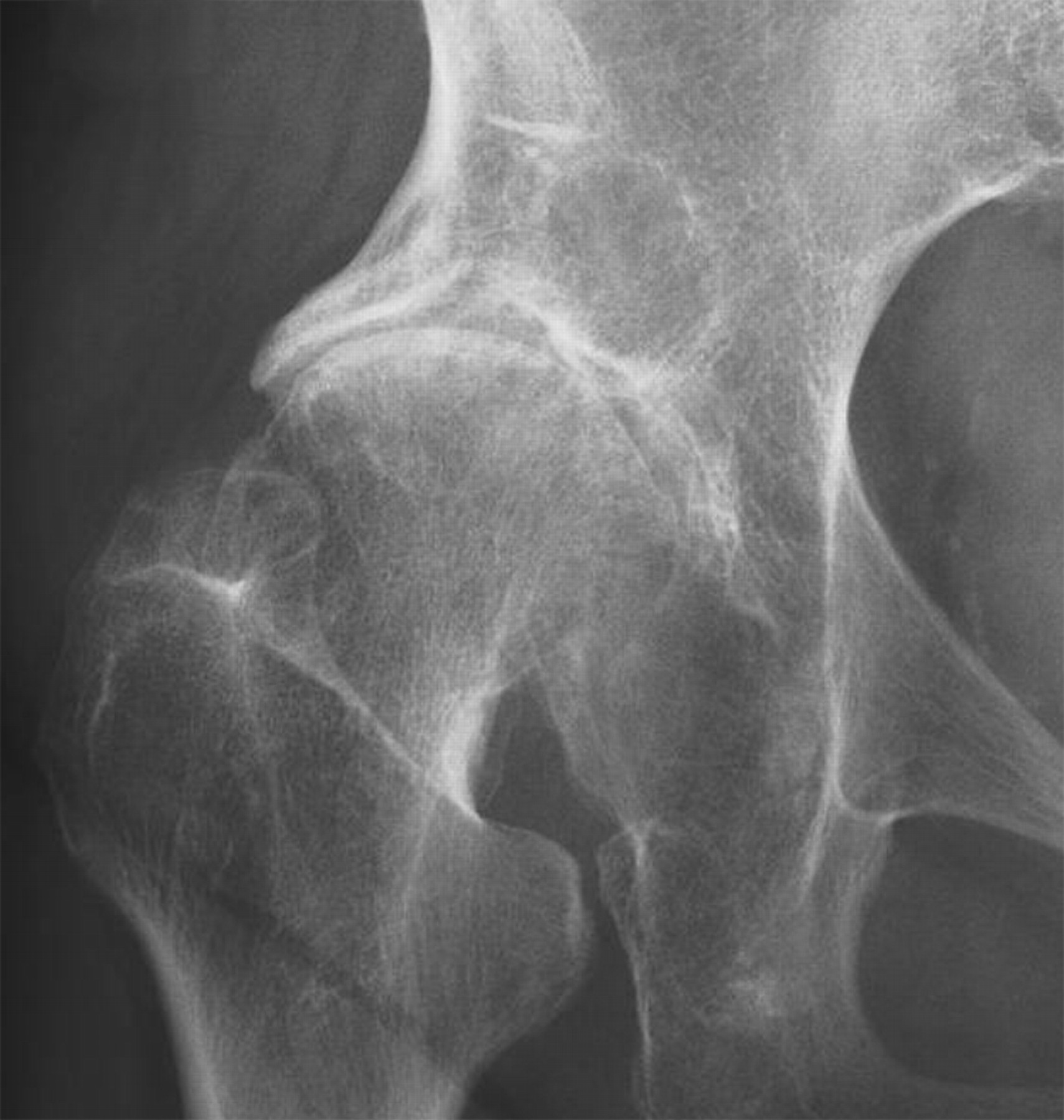 A shelf procedure at a follow-up of 75 years | Bone & Joint