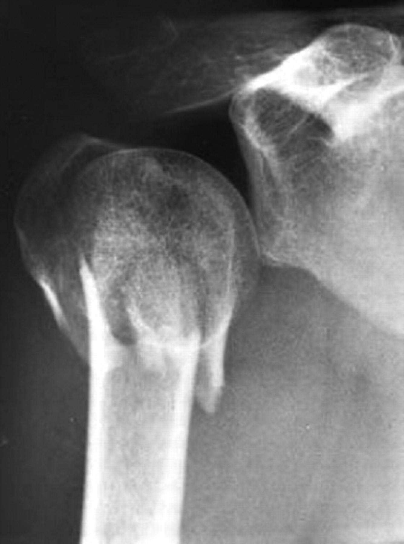 Proximal Humeral Fractures | Bone & Joint