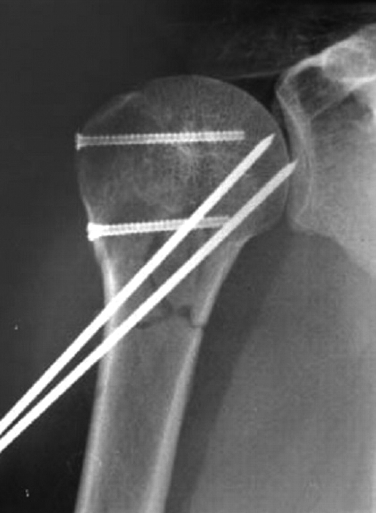 Proximal humeral fractures | Bone & Joint