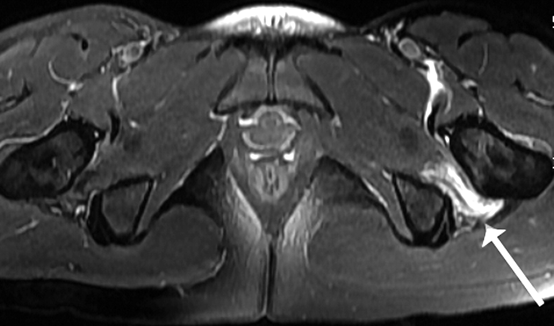 Ischiofemoral Impingement Bone Joint