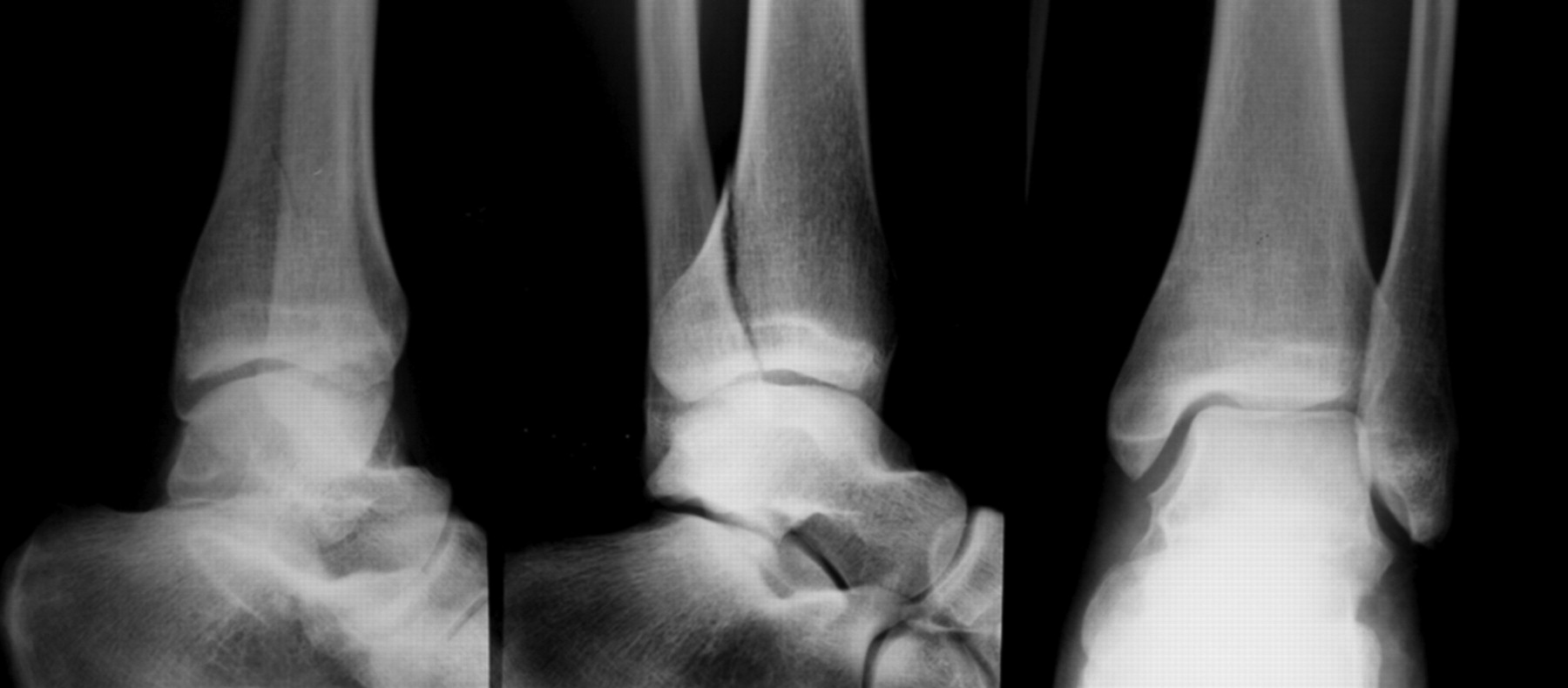 The Outcome At 20 Years Of Conservatively Treated ‘isolated’ Posterior Malleolar Fractures Of