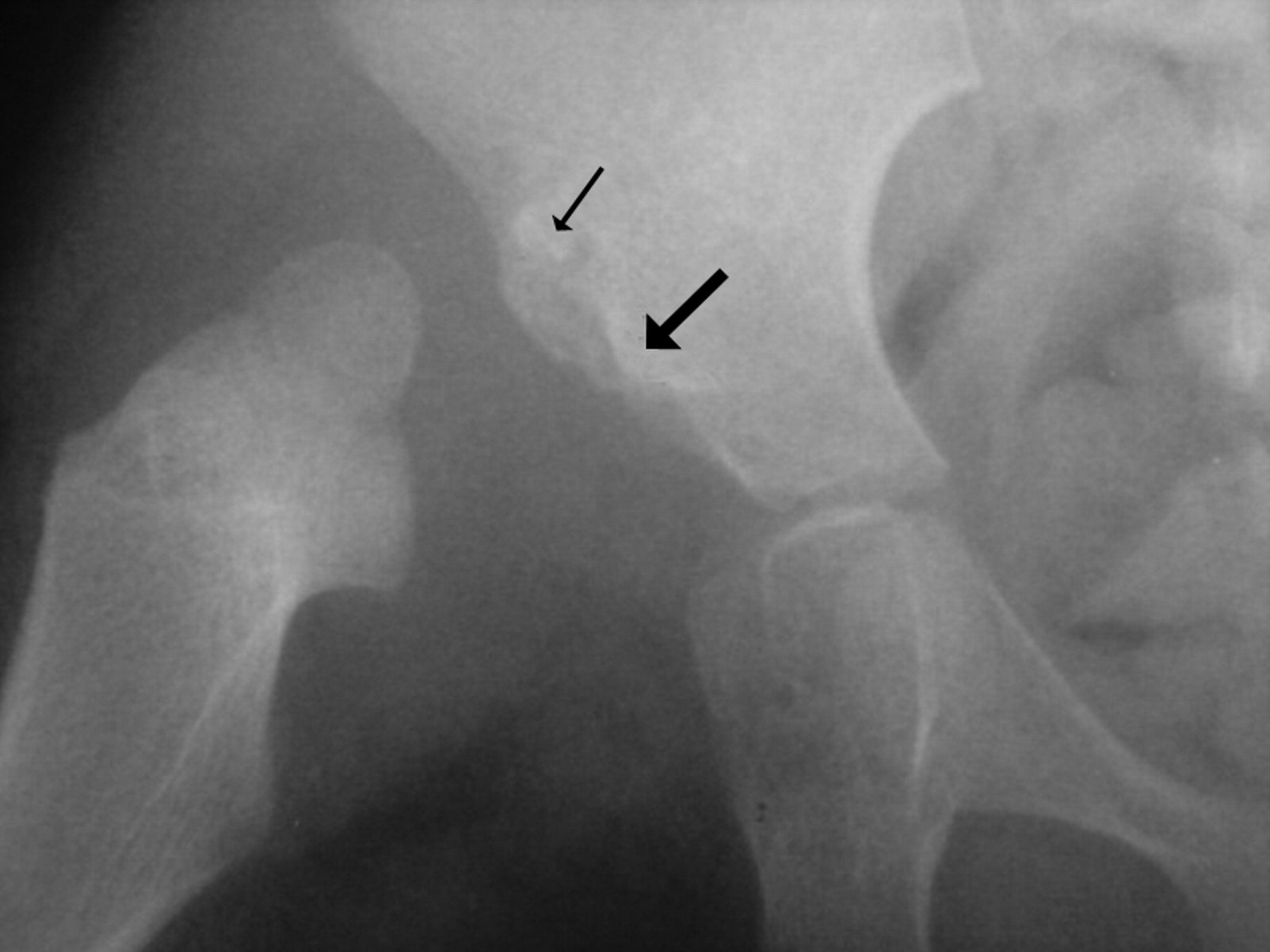 Combined pelvic osteotomy for the bipartite acetabulum in late ...