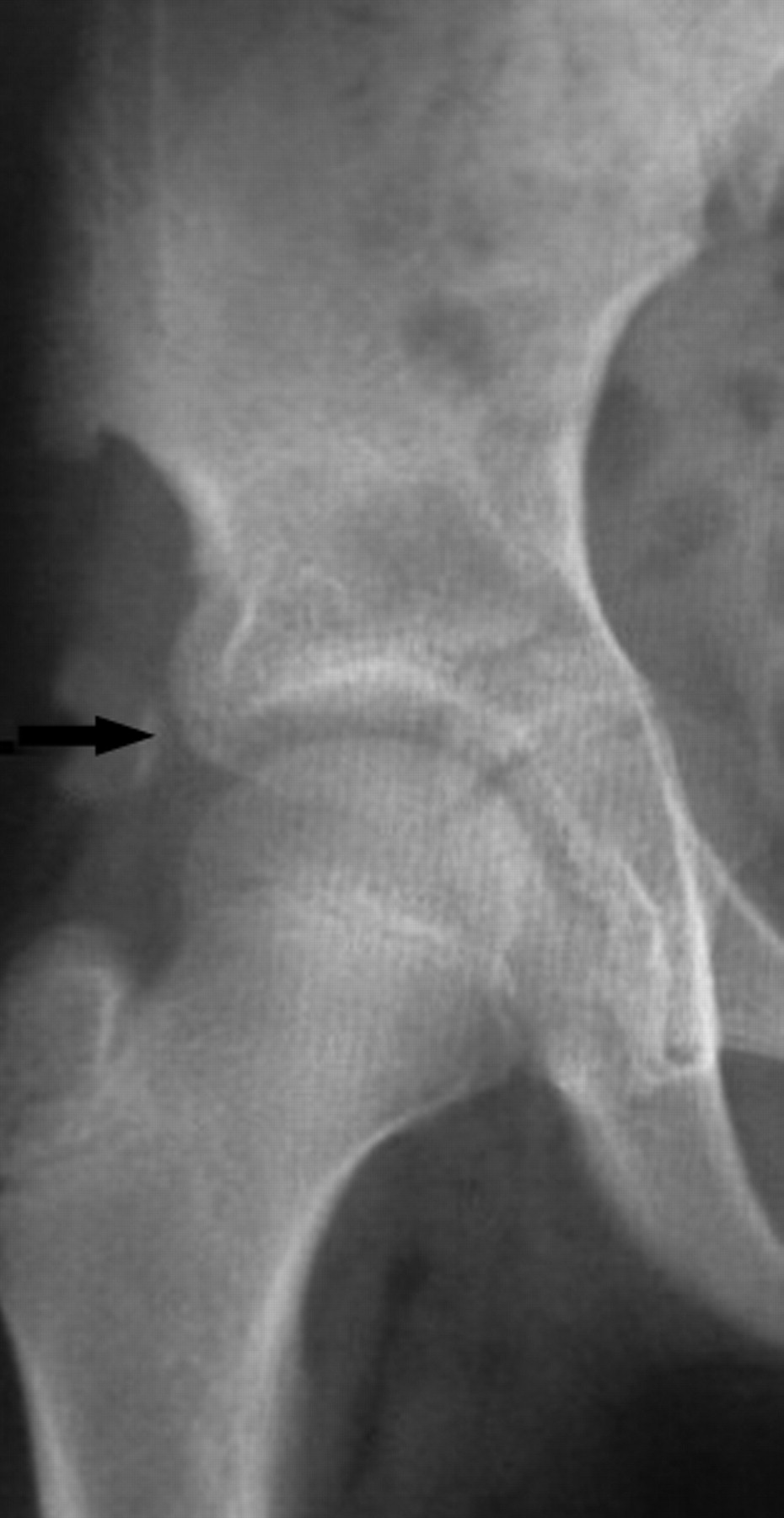 Combined pelvic osteotomy for the bipartite acetabulum in late ...