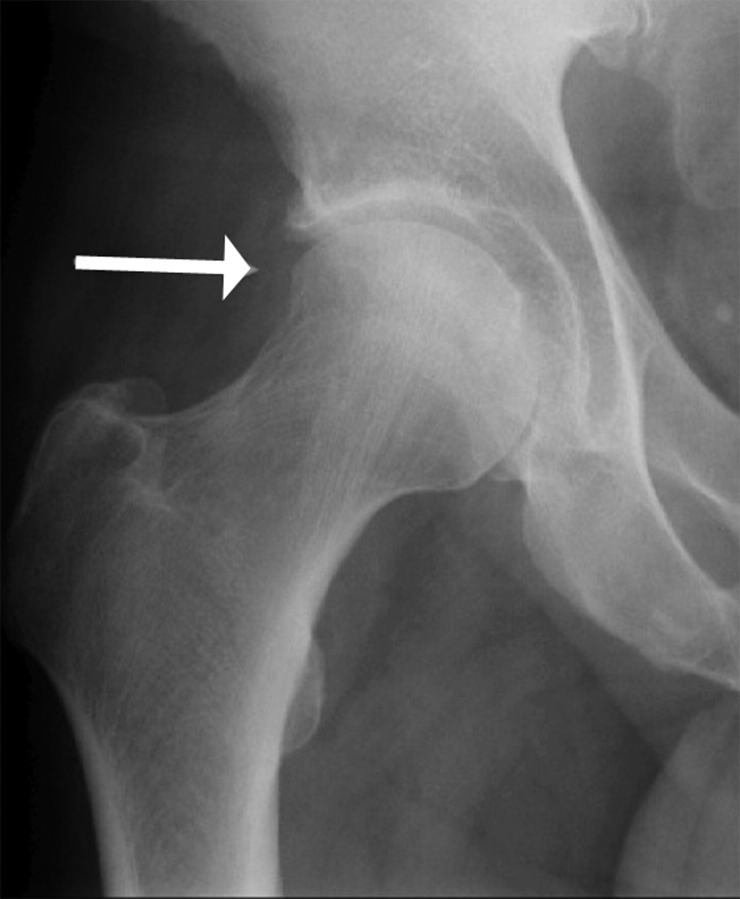 Arthroscopic femoral osteochondroplasty for cam femoroacetabular ...