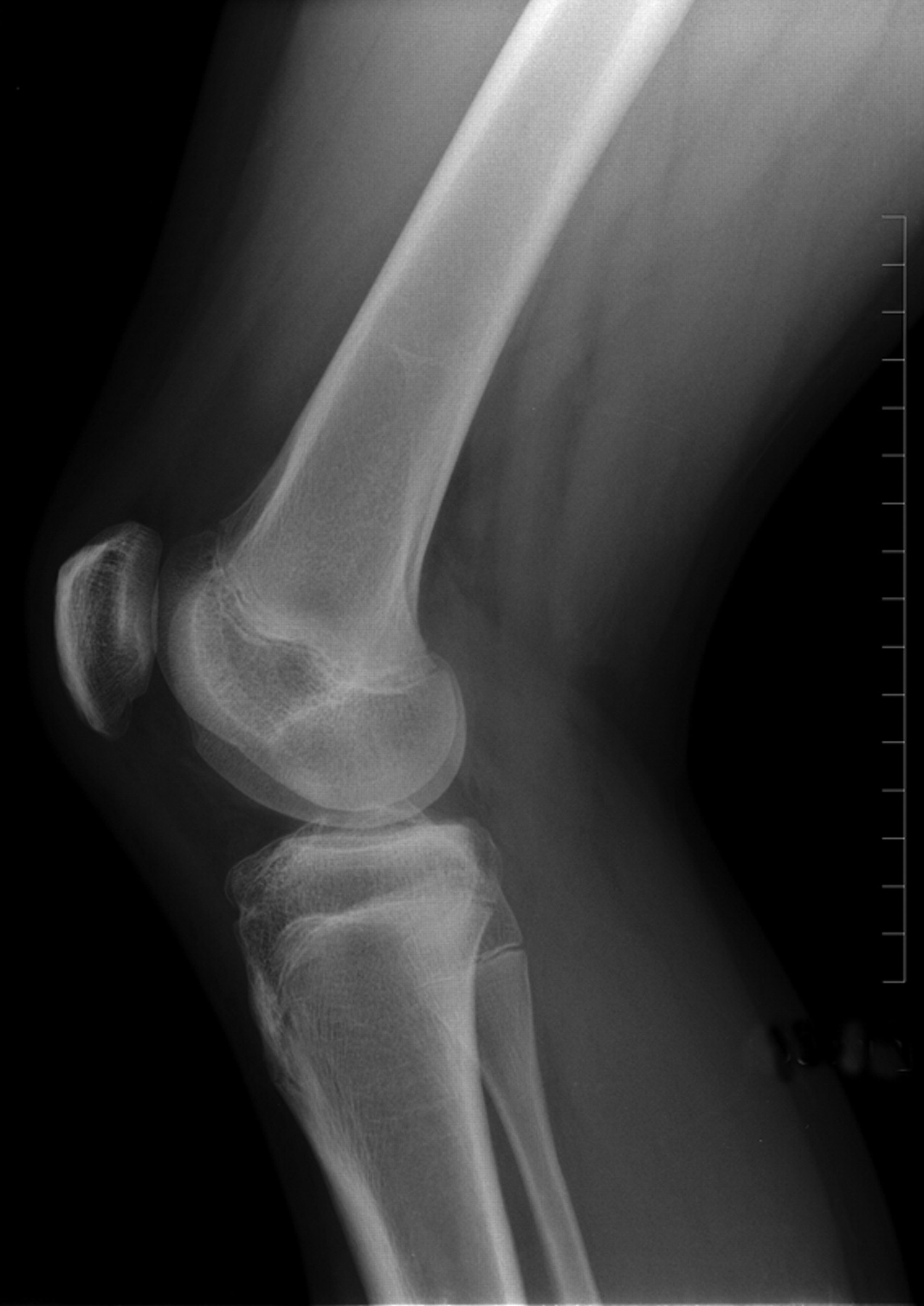 Physeal-sparing reconstruction of anterior cruciate ligament tears in ...