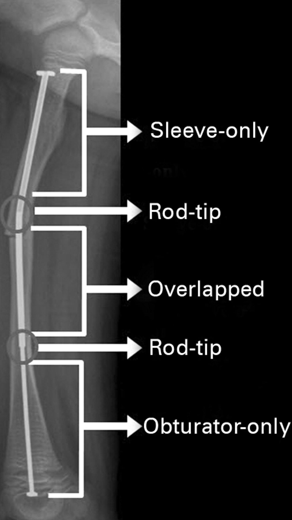 Fracture In Long Bones Stabilised By Telescopic Intramedullary Rods In ...