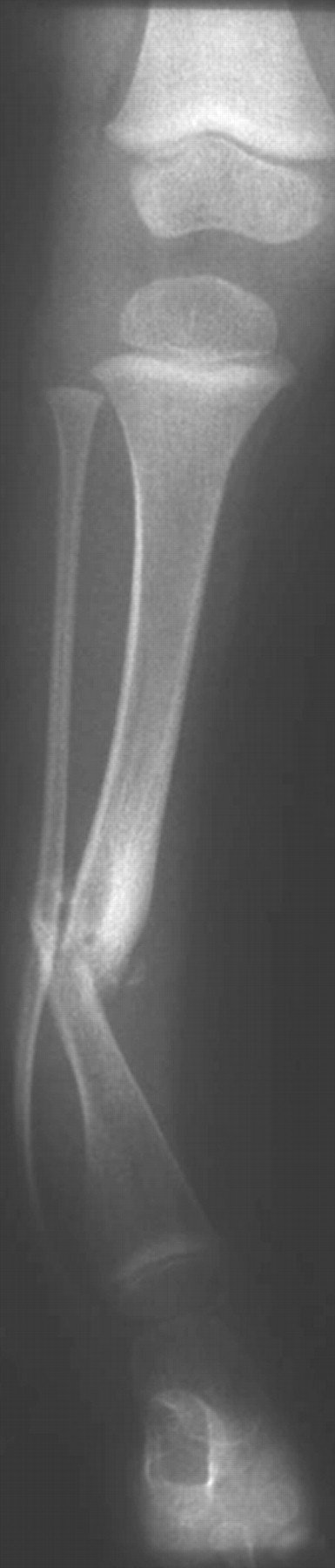 Combined Treatment Of Congenital Pseudarthrosis Of The Tibia Including Recombinant Human Bone