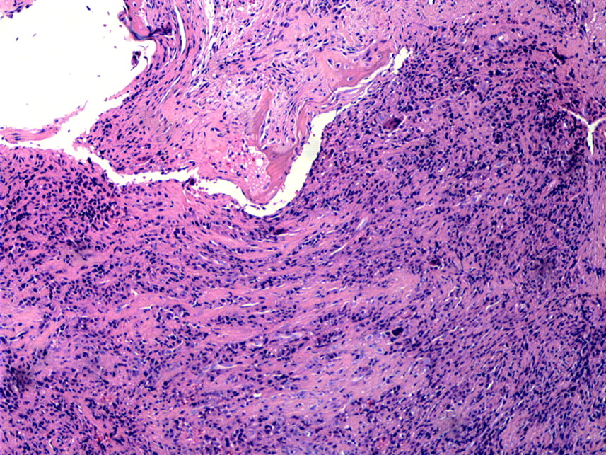 Exceptionally aggressive pigmented villonodular synovitis of the hip ...