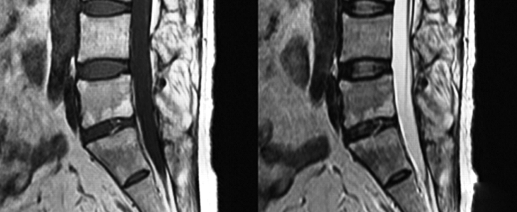 The Andersson Lesion In Ankylosing Spondylitis 