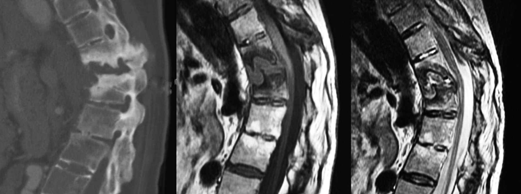 The Andersson lesion in ankylosing spondylitis | Bone & Joint