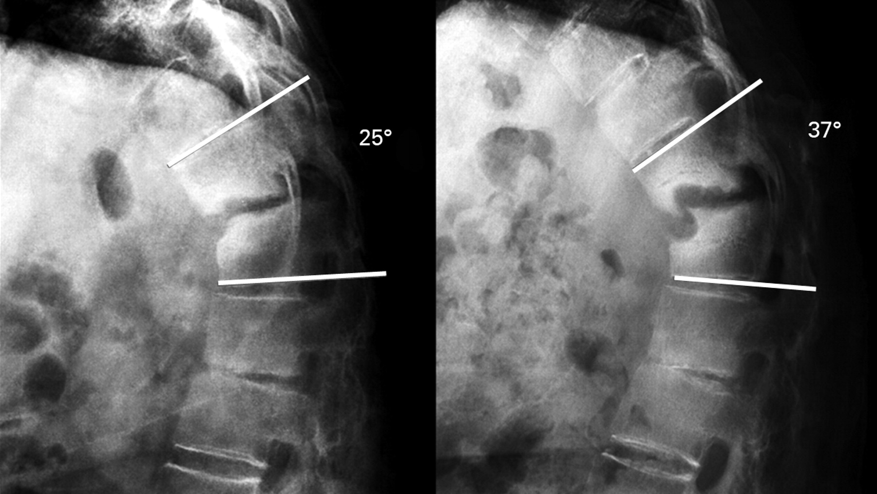 The Andersson Lesion In Ankylosing Spondylitis Bone And Joint