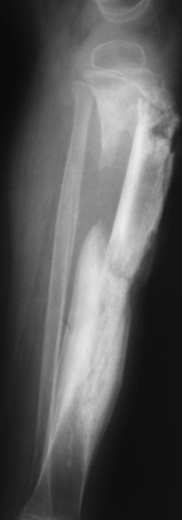 Chronic haematogenous osteomyelitis in children | Bone & Joint