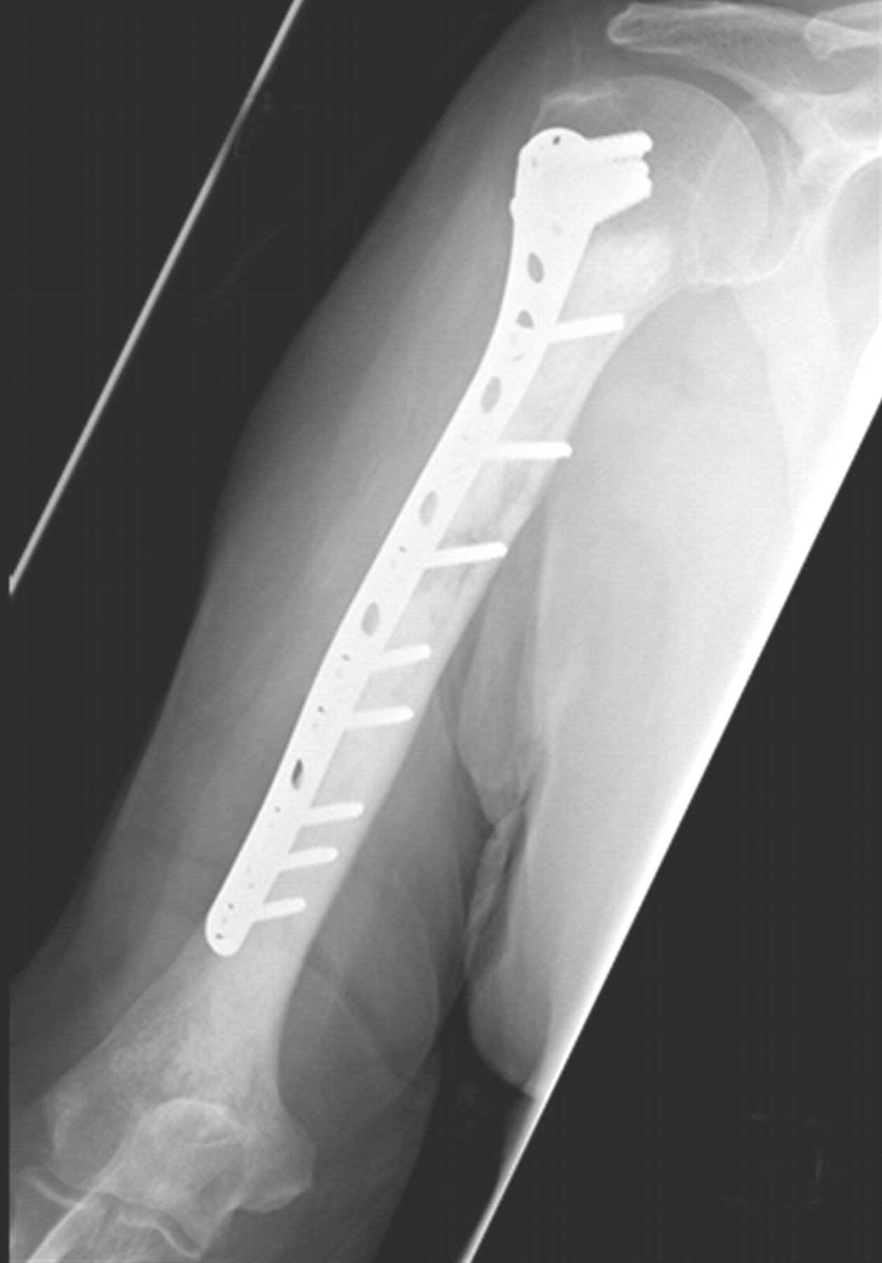 Fixation Of Pathological Humeral Fractures By The Cemented Plate Technique Bone And Joint