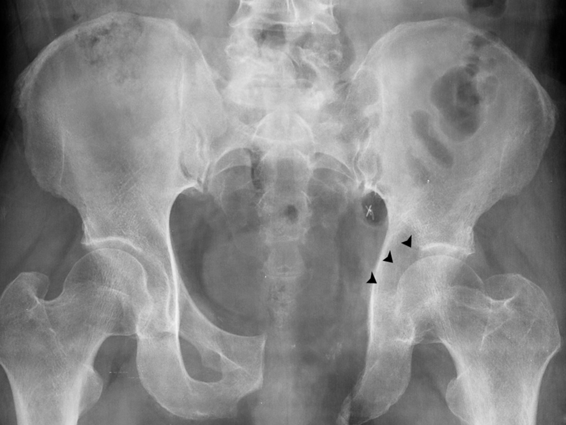 The outcomes of navigation-assisted bone tumour surgery | Bone & Joint