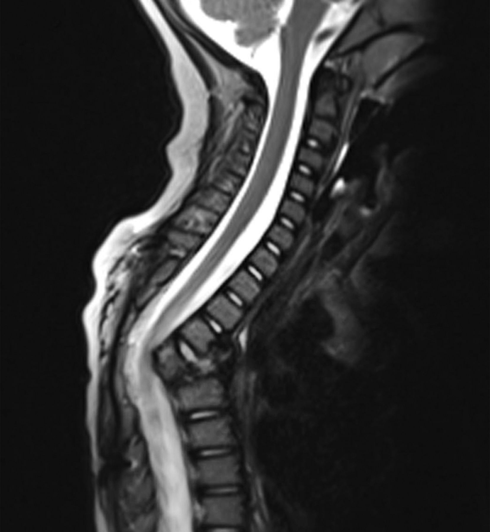 Spondylodiscitis in infancy | Bone & Joint