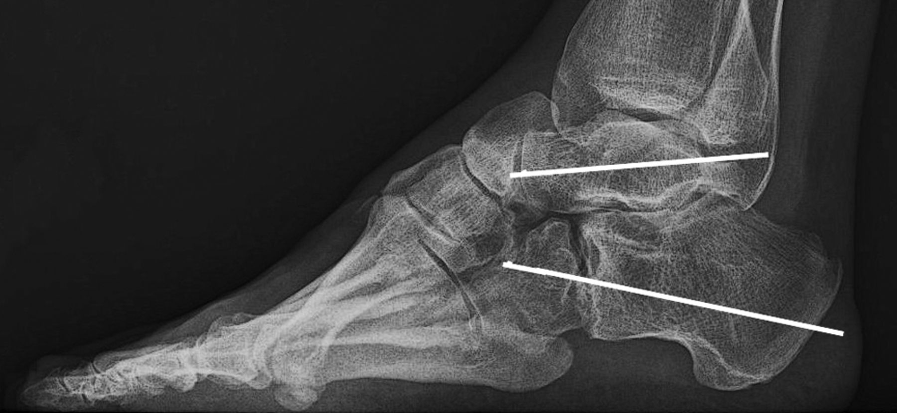 Low prevalence of osteoarthritis in patients with congenital clubfoot ...