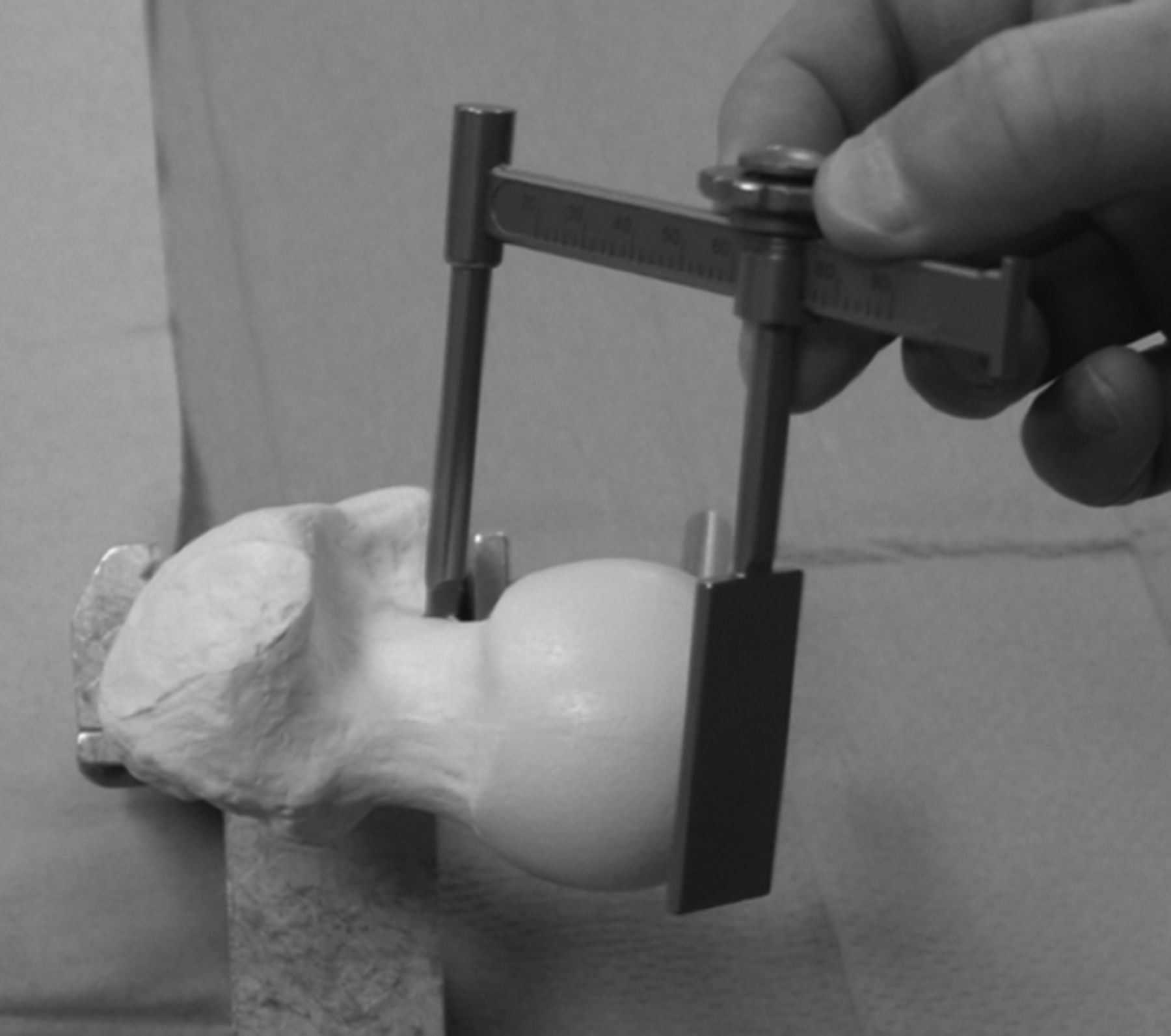 Using A Calliper To Restore The Centre Of The Femoral Head During Total Hip Replacement Bone 6316