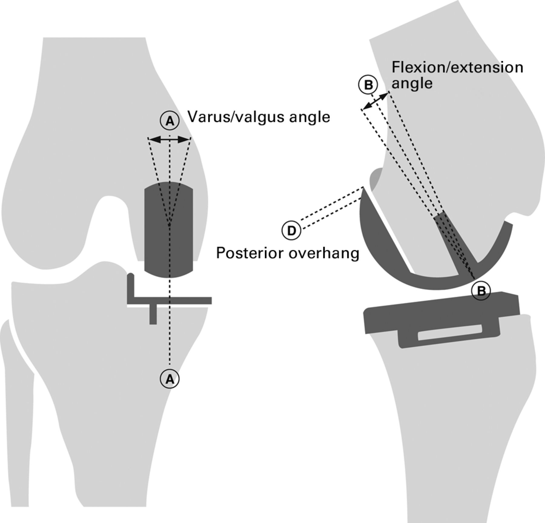 The radiological parameters correlated with the alignment of the