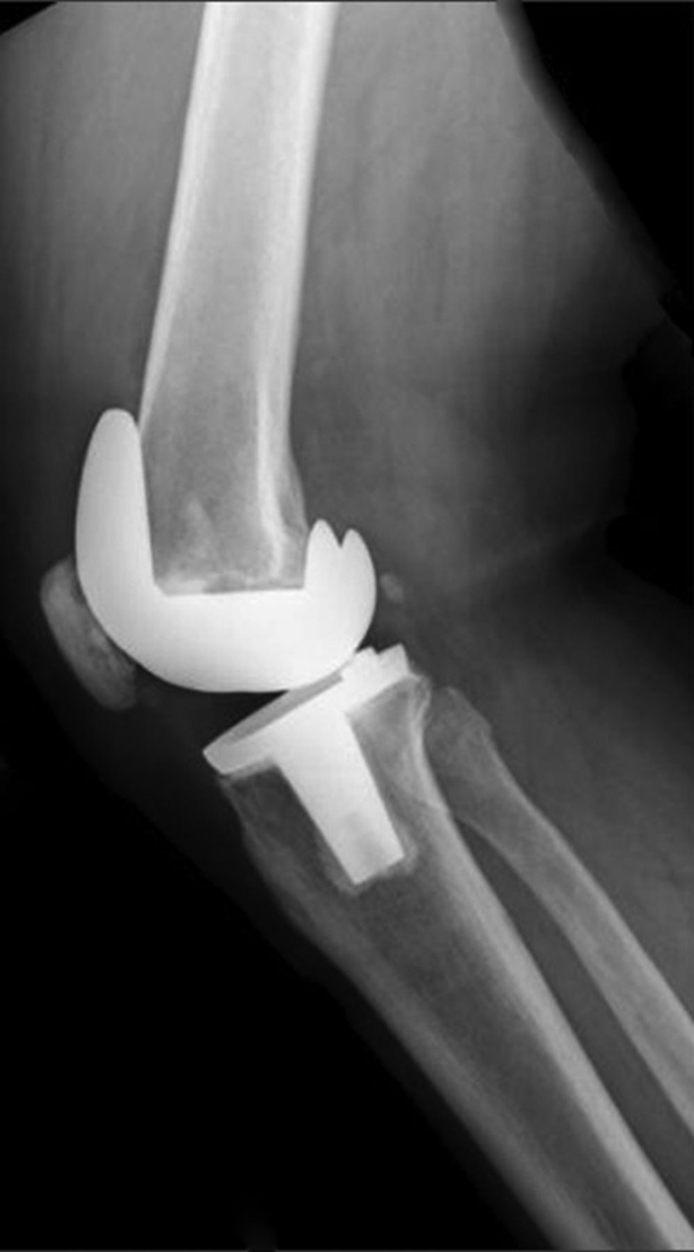 Fixed Flexion Deformity And Total Knee Arthroplasty | Bone & Joint