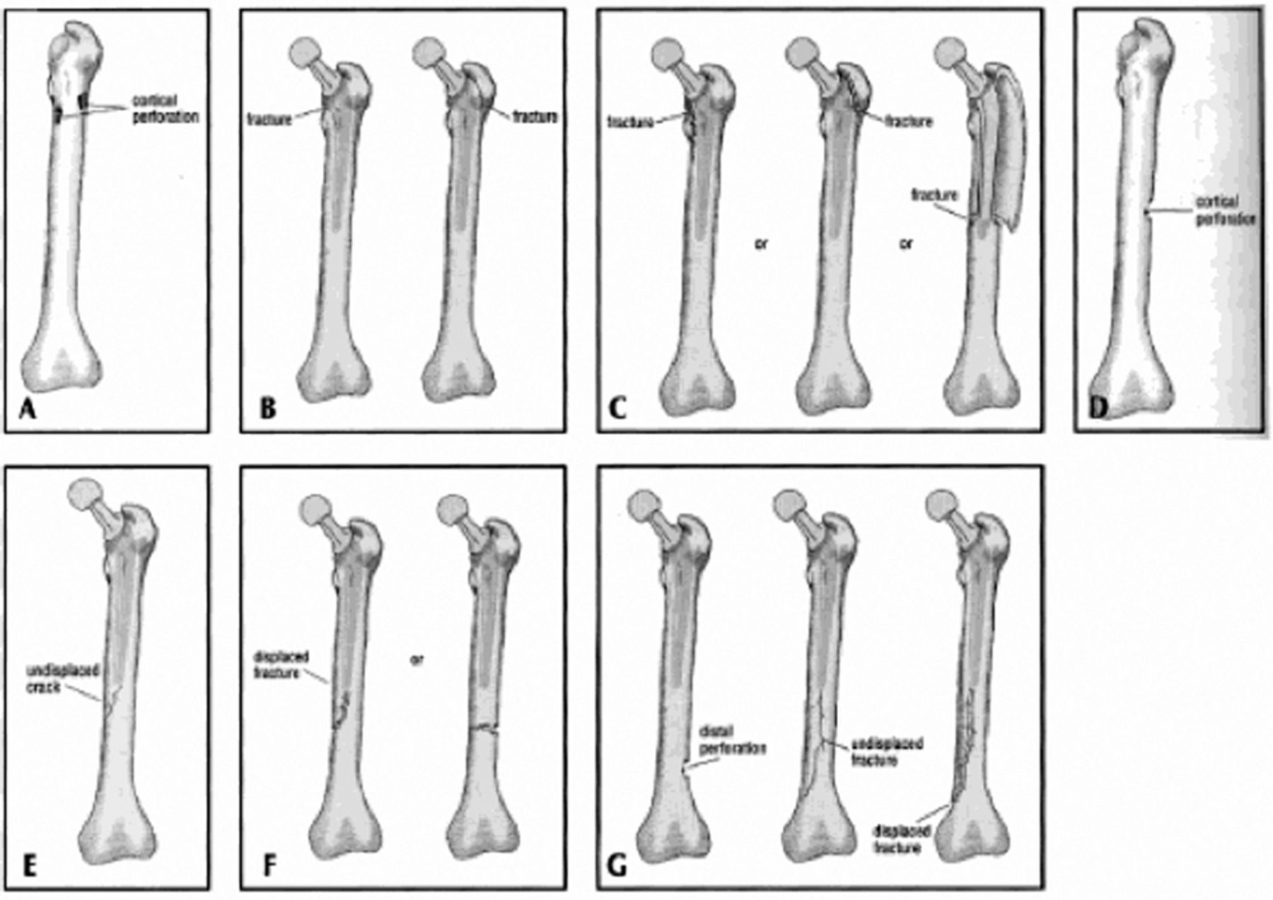 Intra-operative Fractures During THA | Bone & Joint