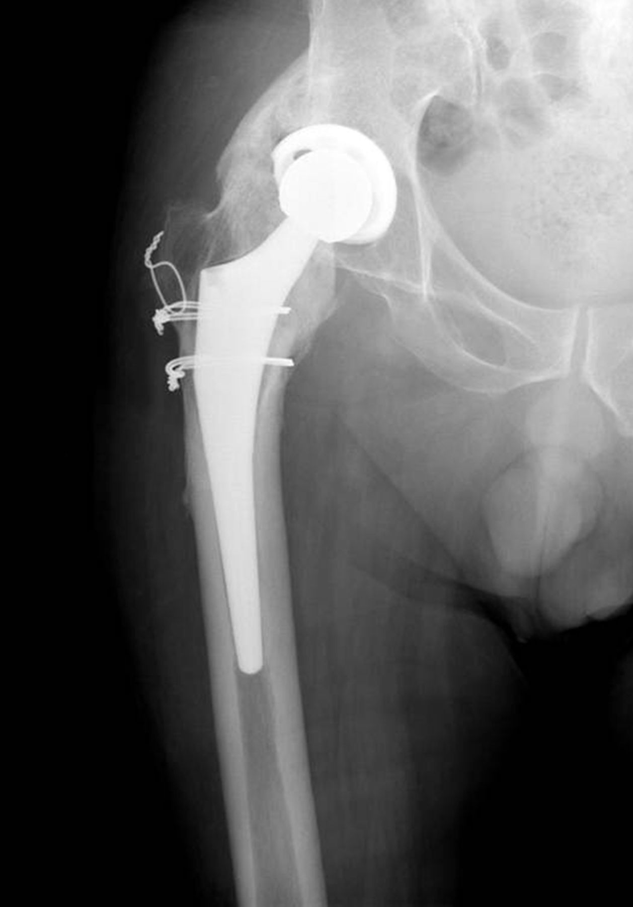 Functional results and complications following conversion of hip fusion ...