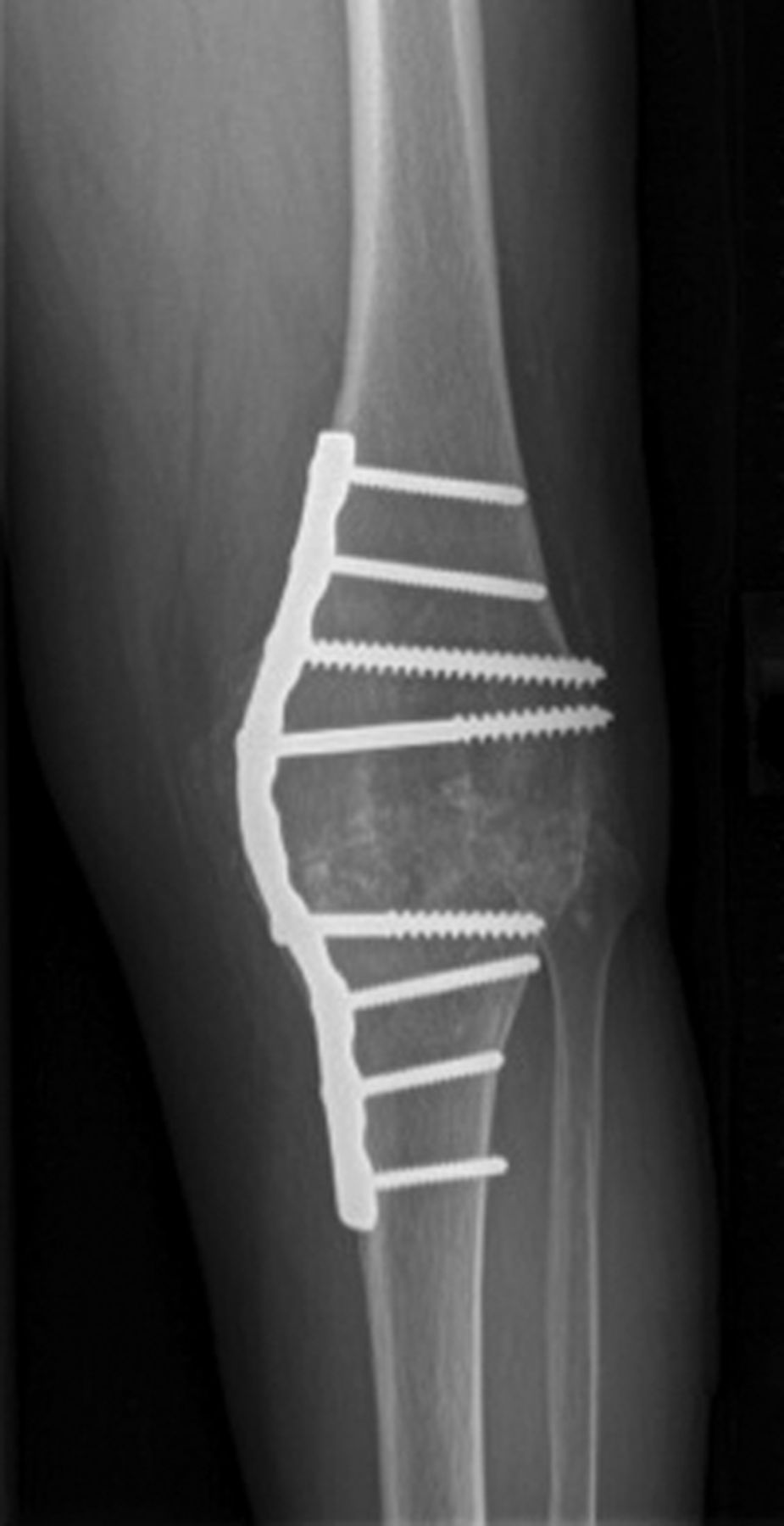 Alternatives To Revision Total Knee Arthroplasty | Bone & Joint